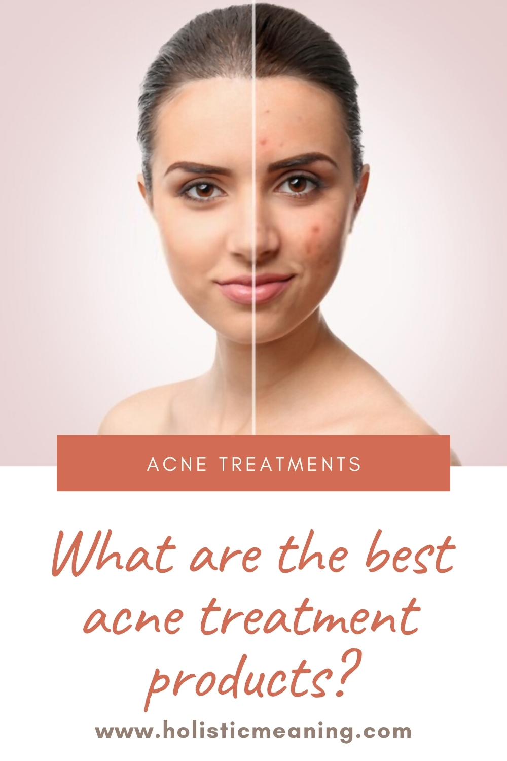 What are the best acne treatment products?