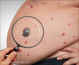 FDA Approved New Regimen for Patients With Melanoma