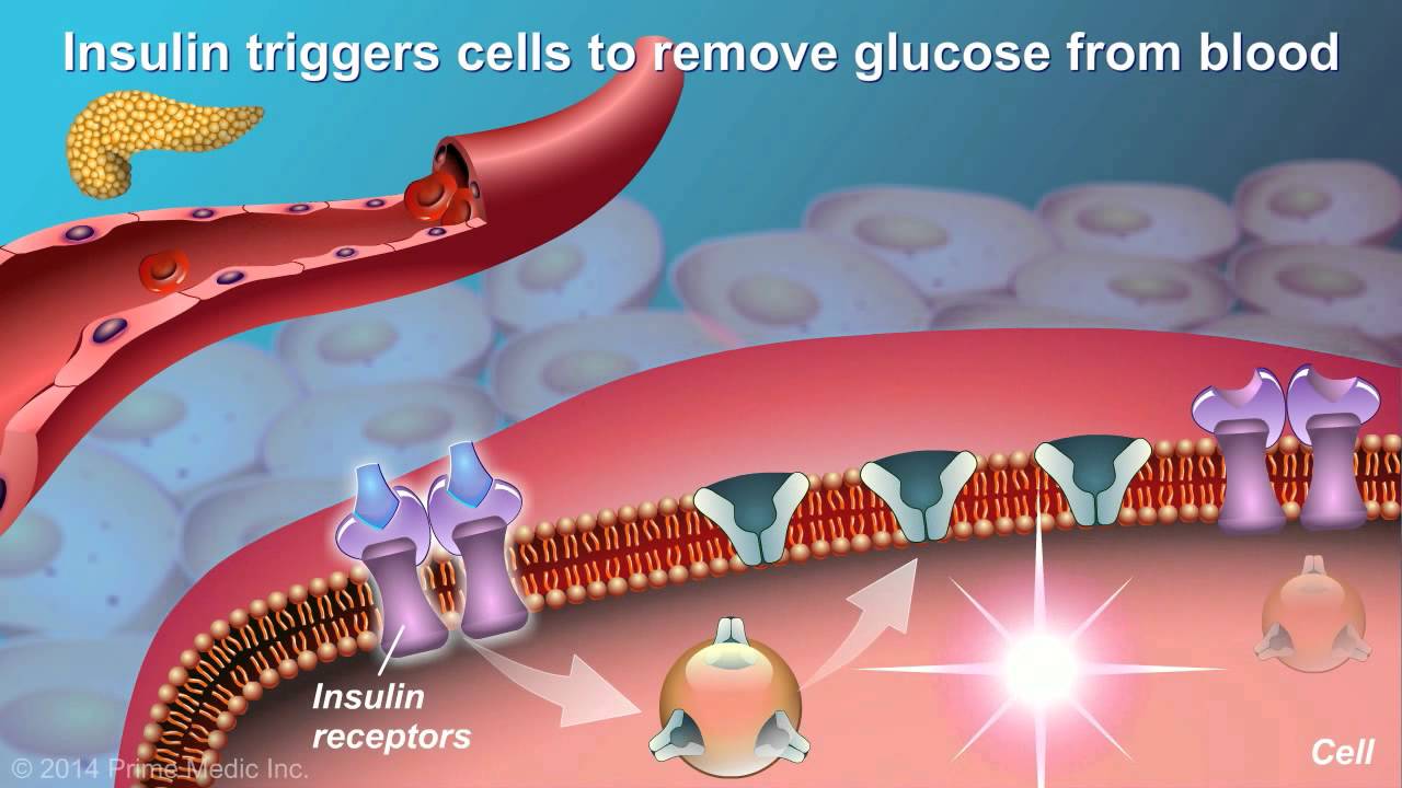 Understanding Type 2 Diabetes