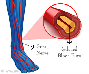 Burning or Tingling Sensation in Feet may be Small Fiber Neuropathy