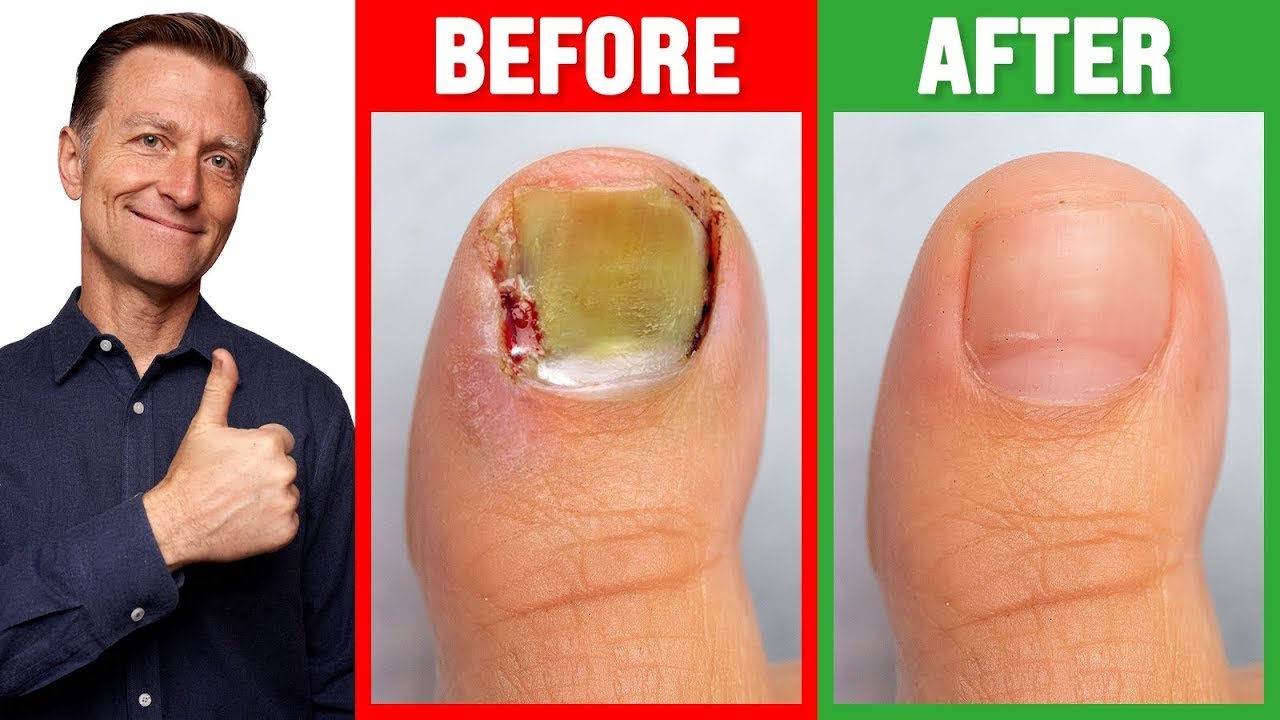 CURE Toenail Fungus for Less than $2.00 – Dr. Berg