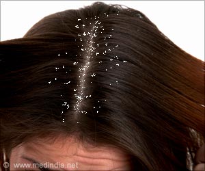 Fight Off the Dandruff This Winter Season by Ten Easy Hacks