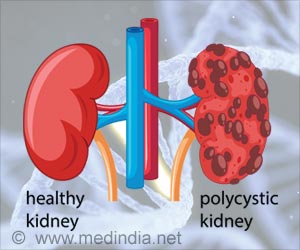 New Tool Assesses Patients Kidney Diseaserelated Knowledge