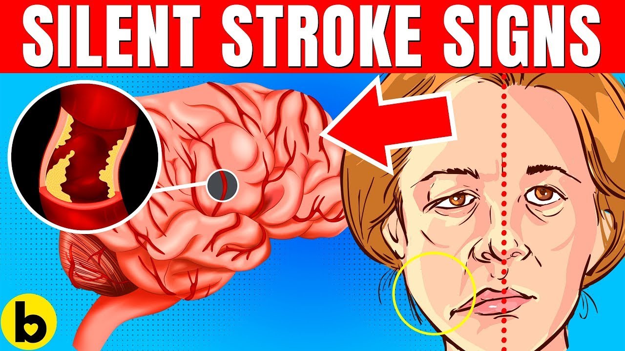 Major Symptoms Of A Silent Stroke That Are Always Ignored