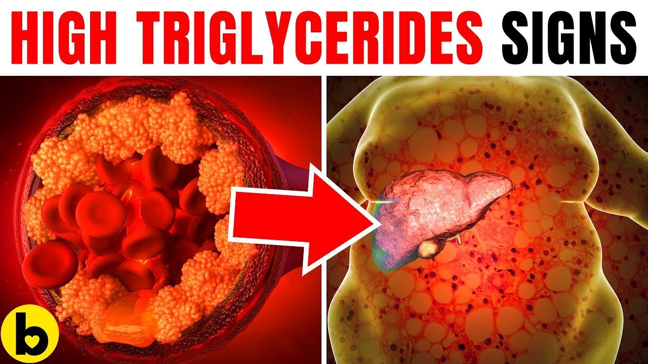 High Triglycerides Warning Signs You Shouldn't Miss