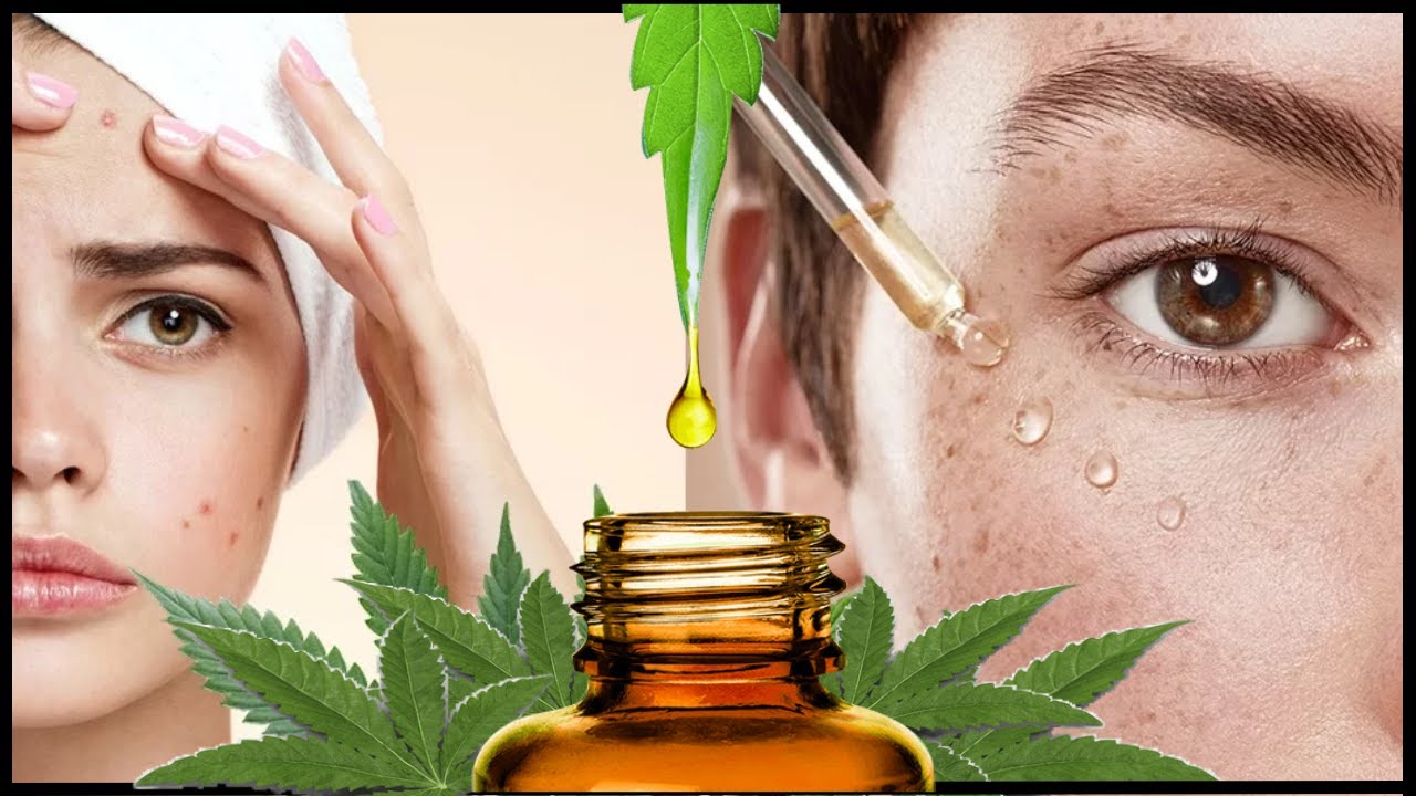 Bye-Bye Acne: Hemp Oil Edition