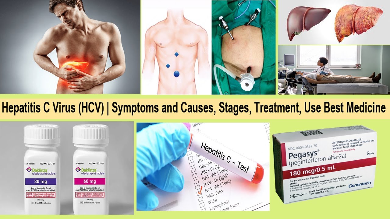 Hepatitis C Virus (HCV) | Symptoms and Causes, Stages, Test, Treatment, Use Best Medicine