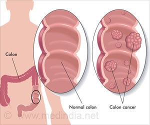 Oral Bacteria Can Trigger Growth of Colon Cancer