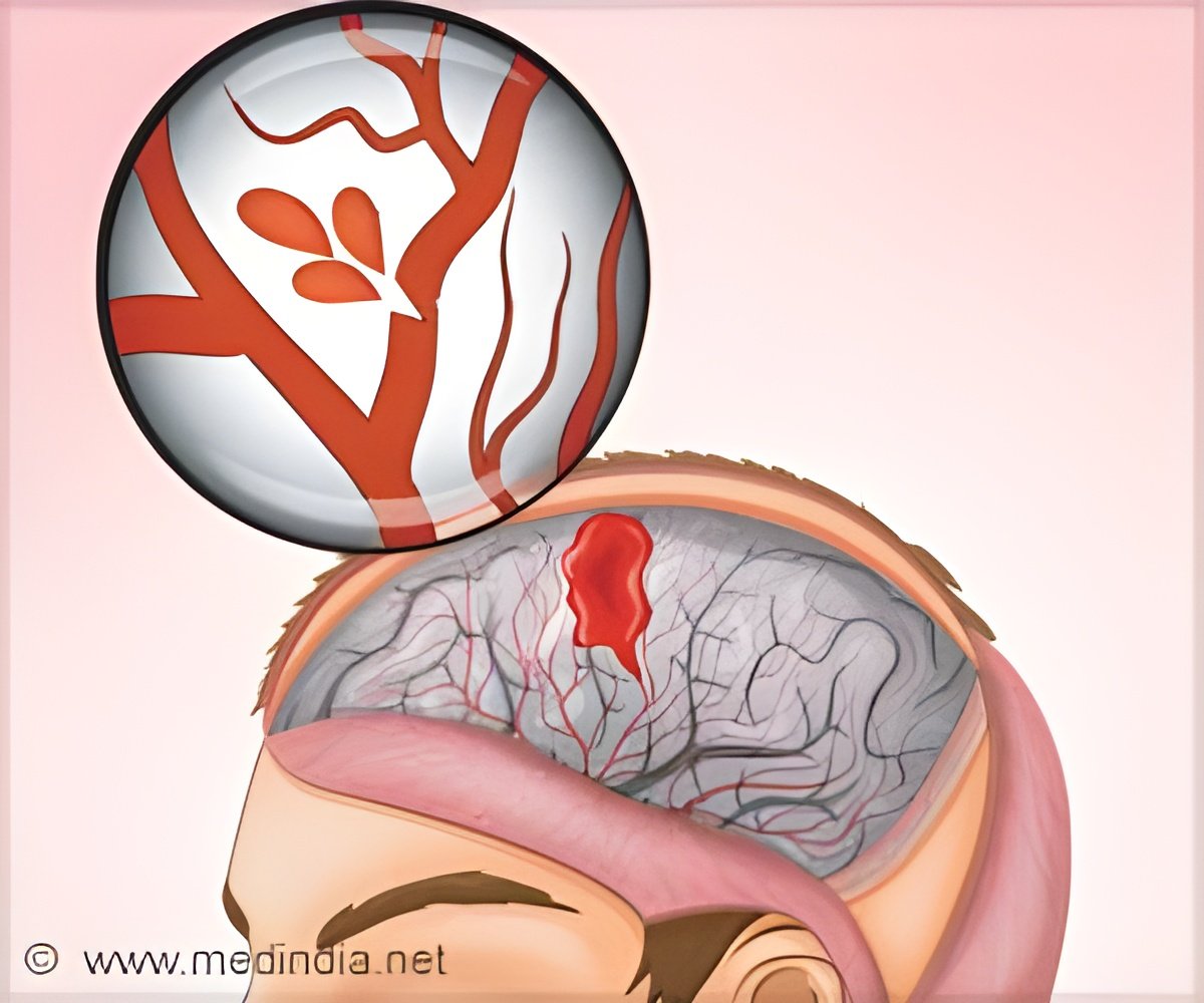 Early Blood Pressure Control’s Dual Impact in Acute Stroke