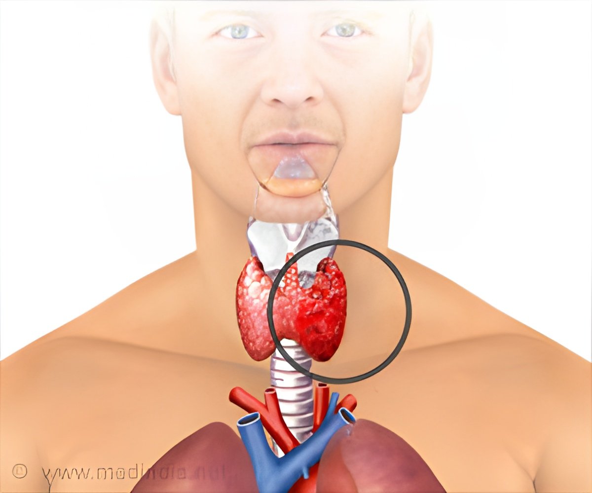 Autoimmune Disorders Independent of Monoclonal Gammopathy