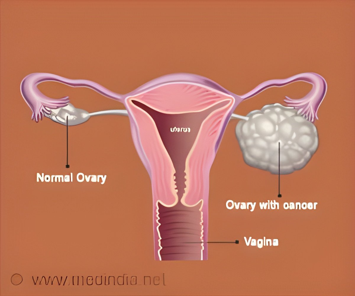 At-Home Swab Tests for Endometrial & Ovarian Cancer Detection