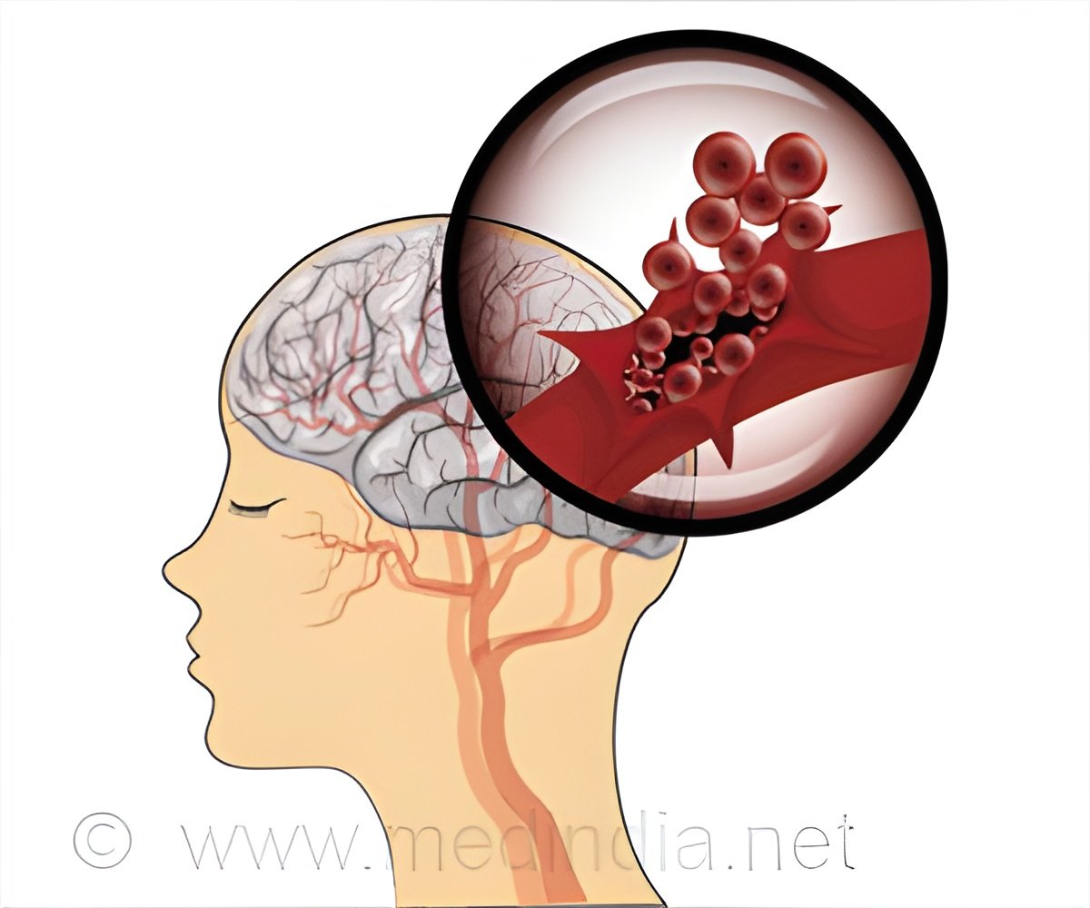 Two Proteins Linked to Increased Stroke Recurrence Risk