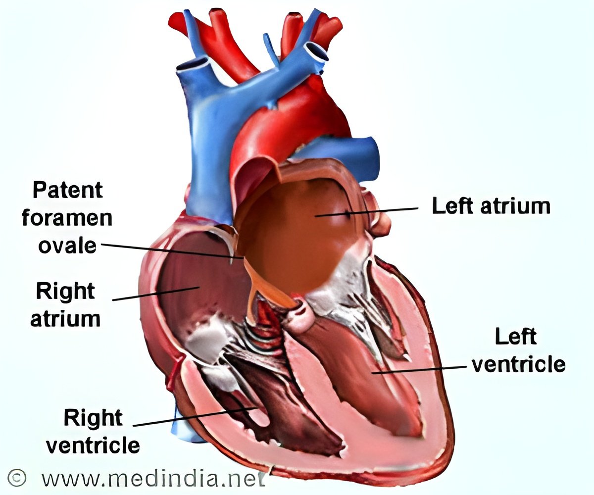 Mapping Strategies to Mitigate Heart Attack Impact