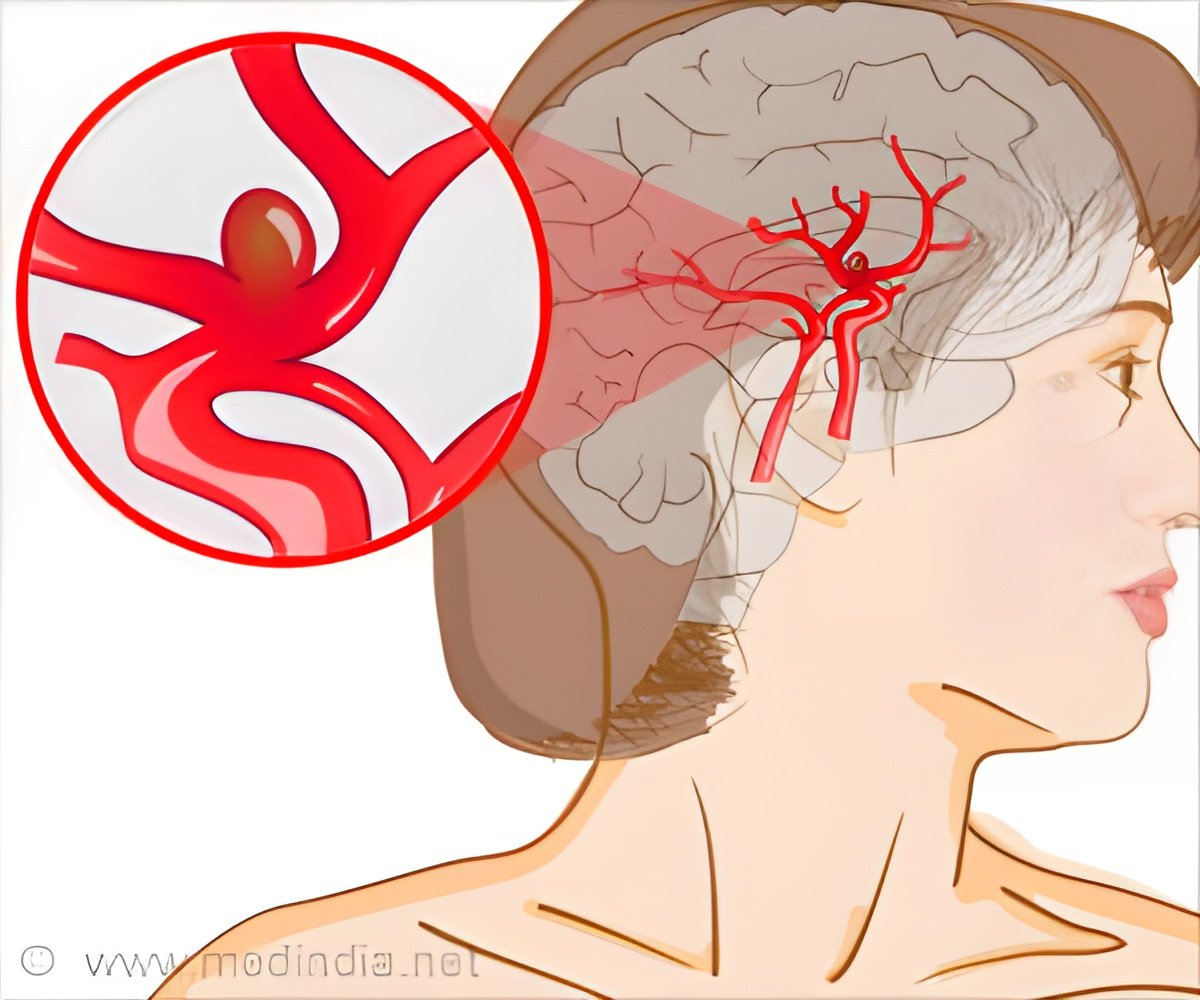 Psychological Toll of Unruptured Aneurysms