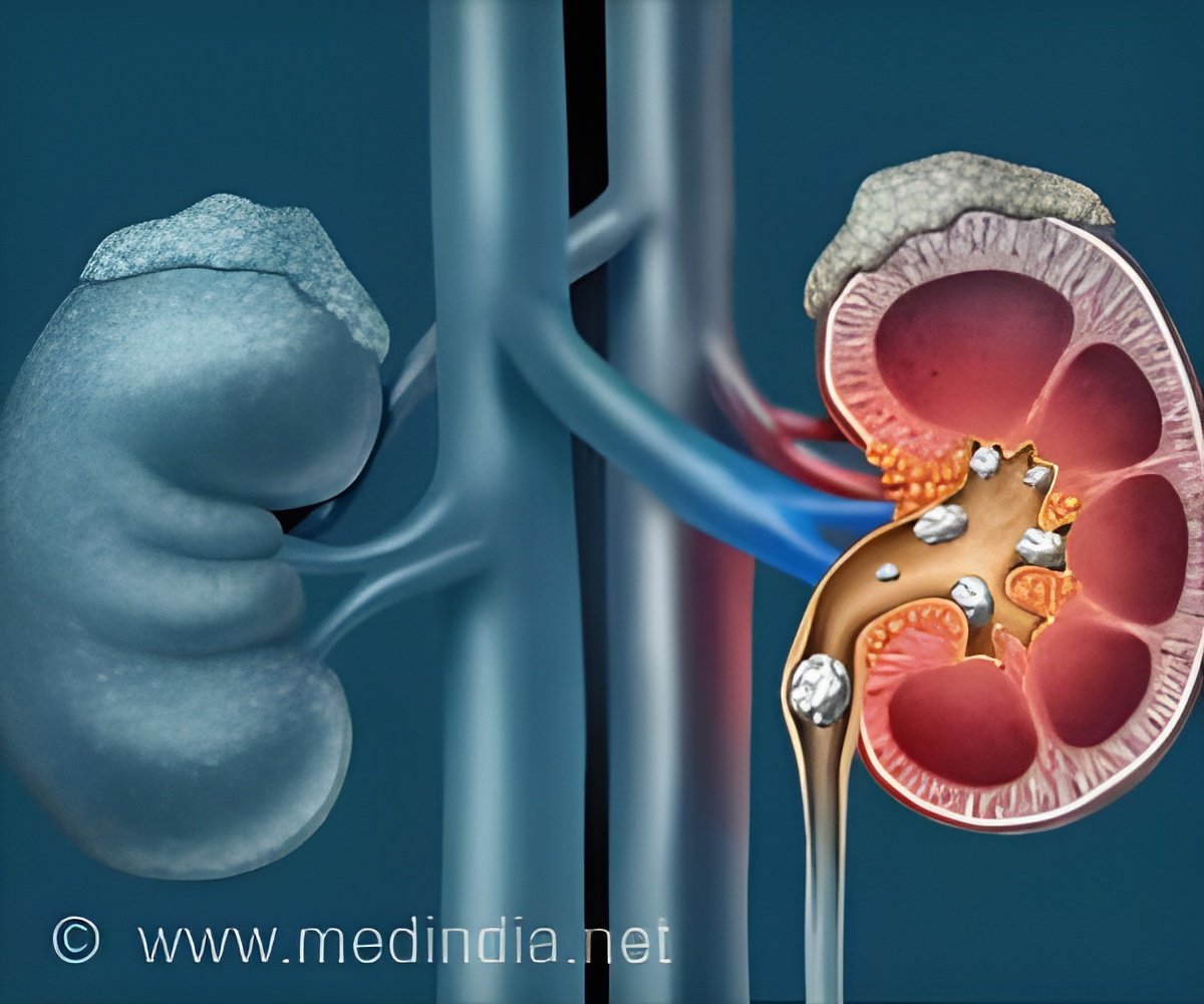 New Ultrasound Technique Reduces Kidney Stone Recurrence