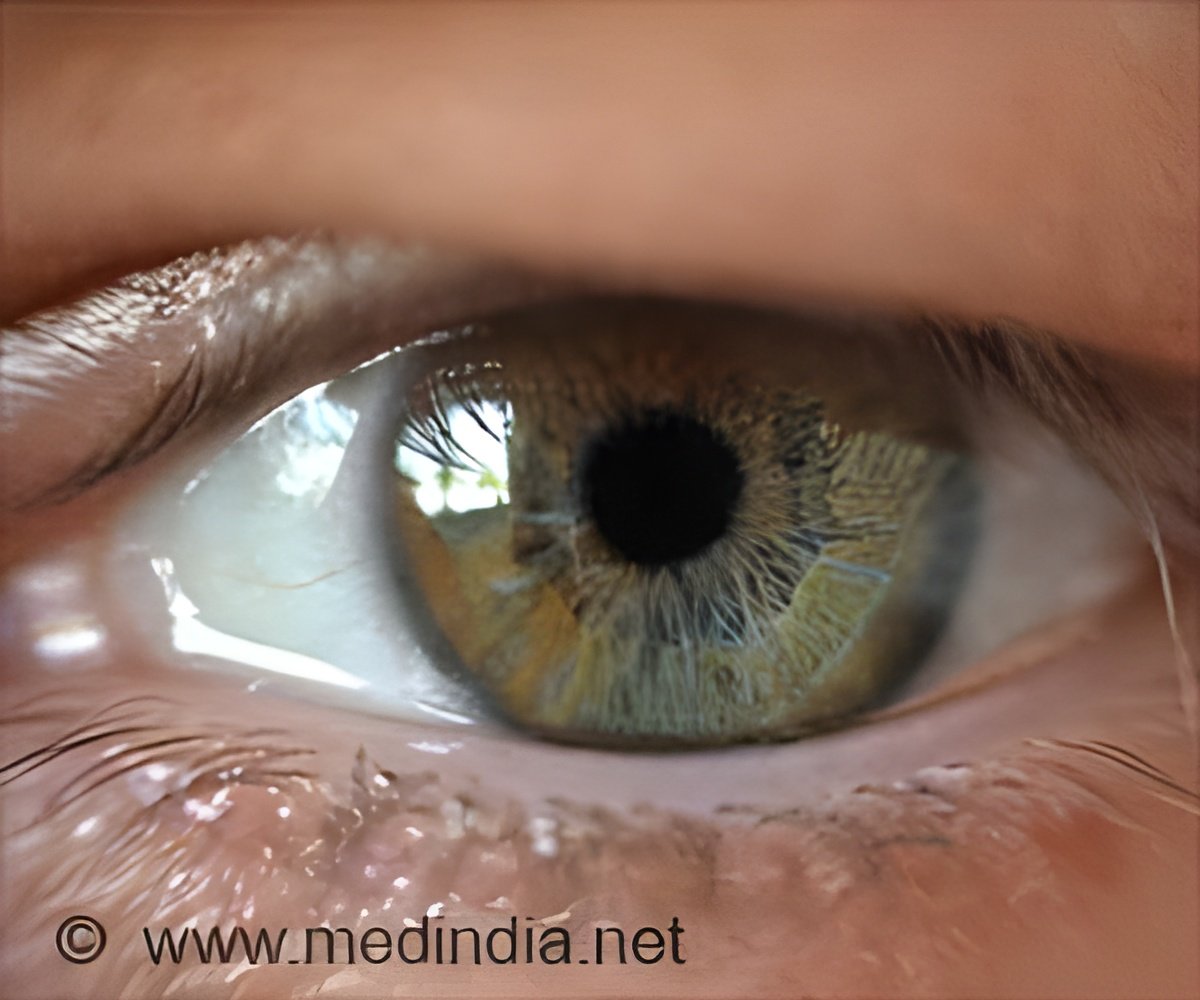 Anterior Uveitis Treatment Through Bloodletting Therapy