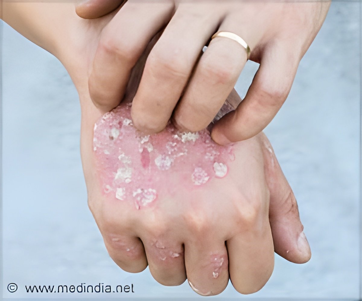 Could a Hormone Be the Cause of Psoriasis?