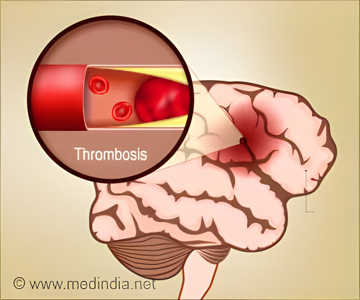 Rising Stroke Rates in Sickle Cell Disease