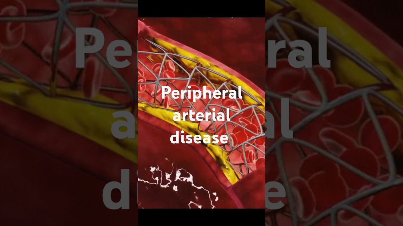 Peripheral arterial disease#medicine #healthtips#health #healthcare#symptoms #treatment#arteries