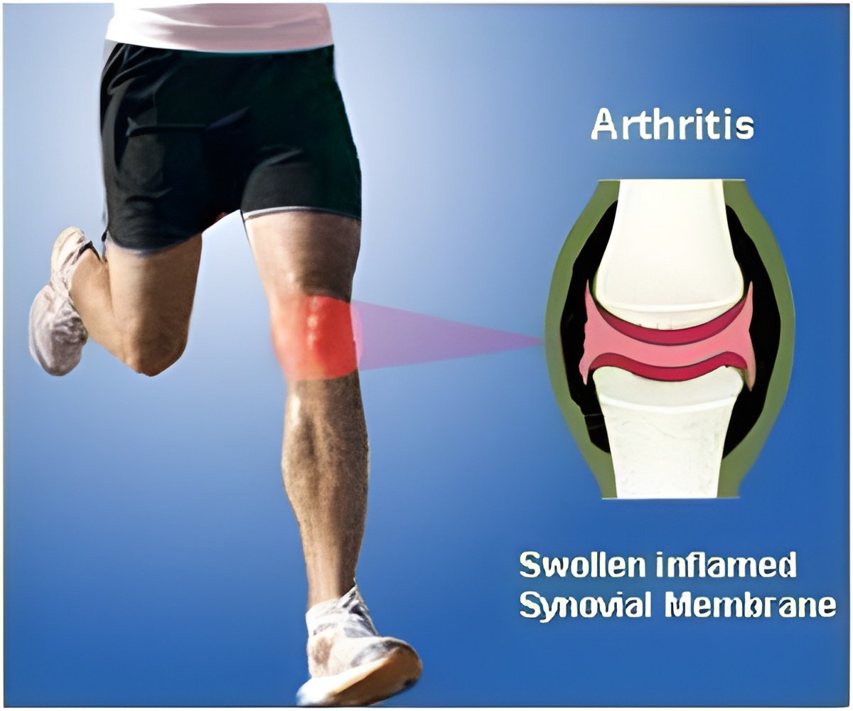 How Deeper Arthritis Understanding Improves Patient Outcomes