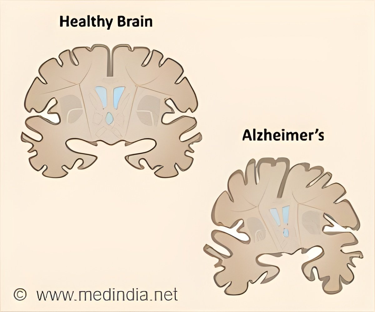 Unpredictable Path of Brain Shrinkage in Alzheimer’s Patients