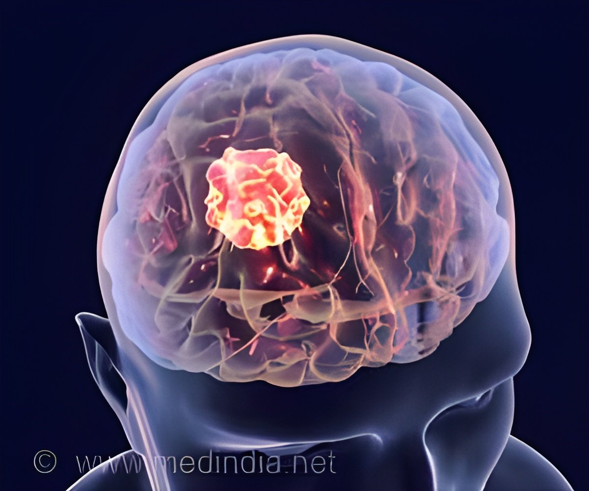 Amyotrophic Lateral Sclerosis Drug May Help Battle Against Incurable Glioblastoma