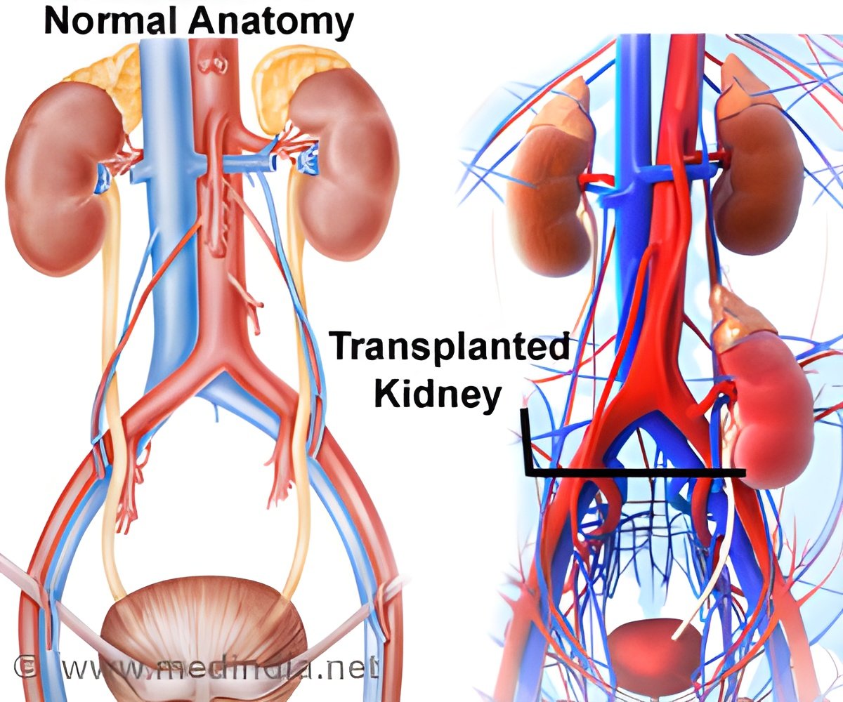 Impact of Microvascular Inflammation on Kidney Transplant Rejection