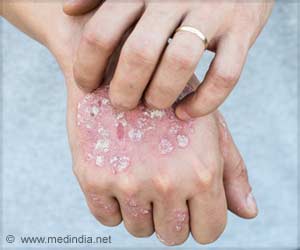 Psoriatic Disease and the Family