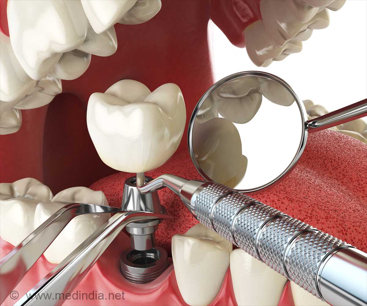 Growth and Advancements in Dental Implant Surgery