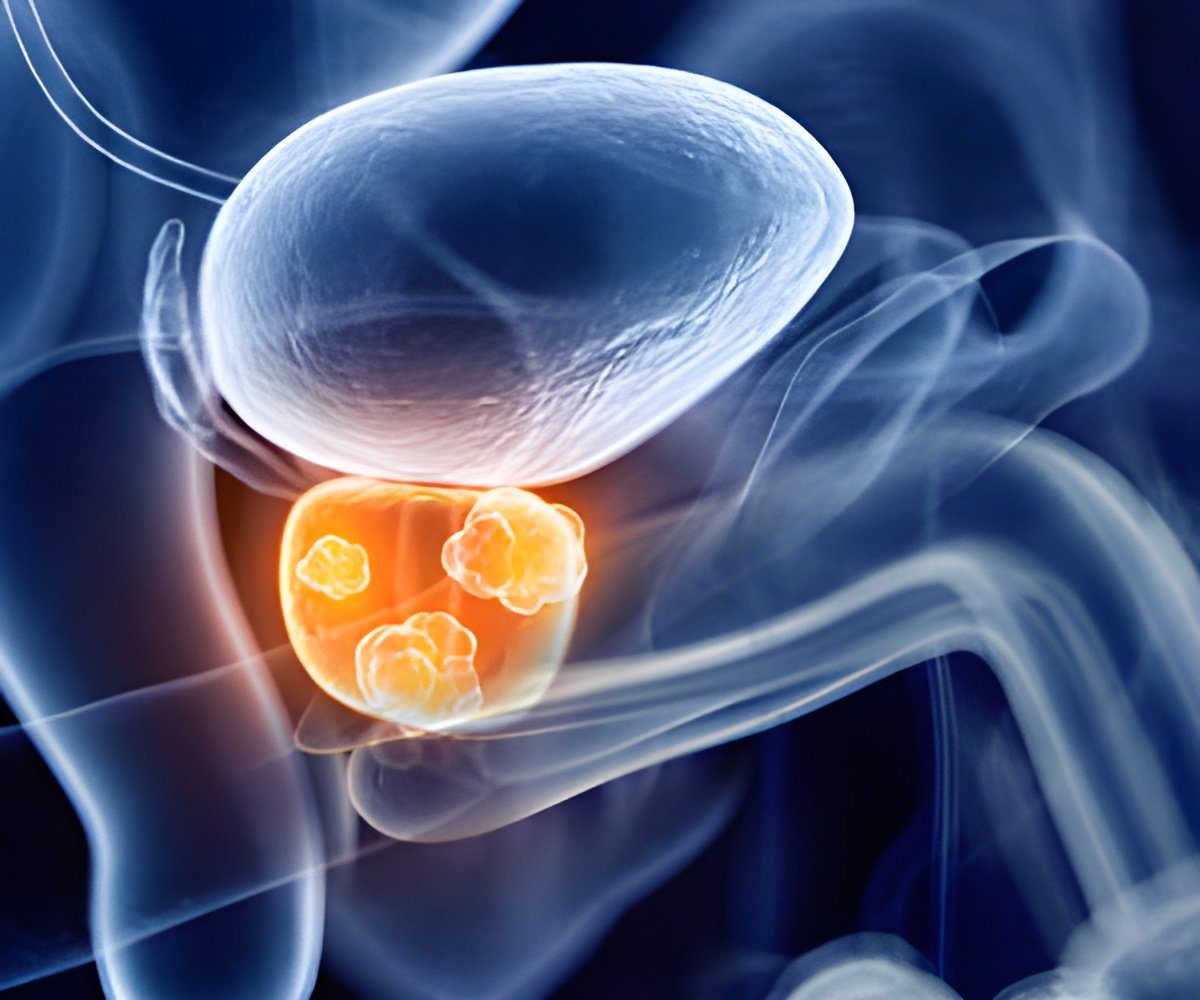 Is Prostate Cancer Treatment Worth the Risk?