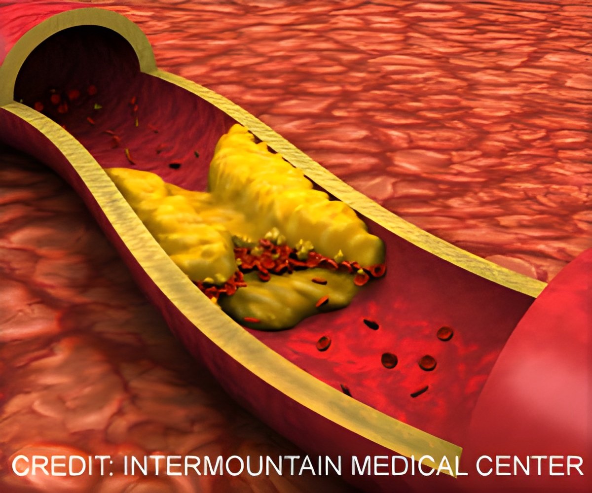 The Hidden Lipids Behind Trans Fat-Induced Heart Disease