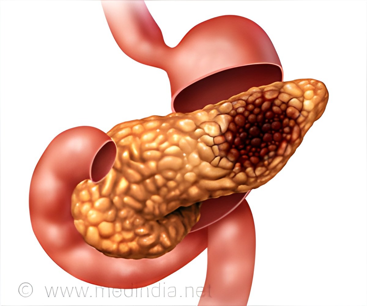 Early Detection of Pancreatic Cancer Using Liquid Biopsy