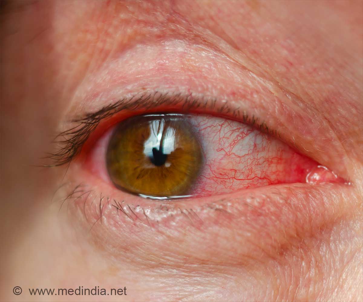 Red Eyes After Swimming? How to Protect Your Eyes from Pool Irritation