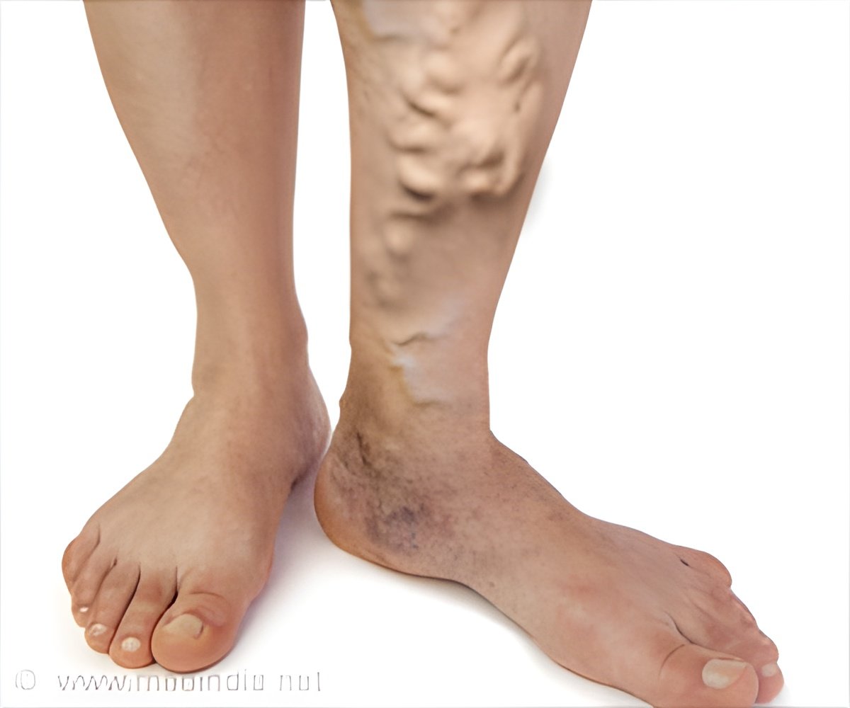 One in Four Indians Affected by Varicose Veins