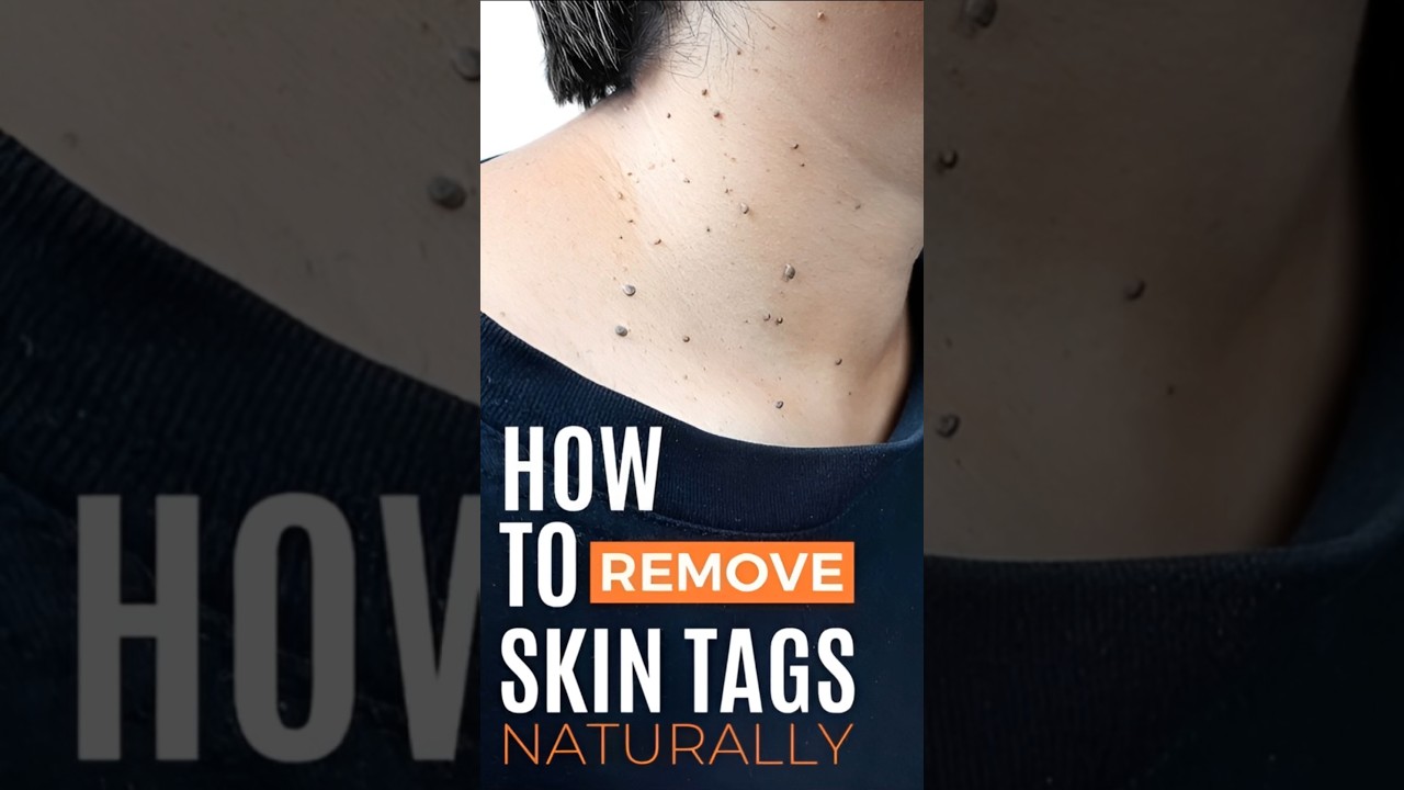 5 Natural Ways to Remove Skin Tags. #health #facts #food #usa #america #uk #skincare #skin #skintags