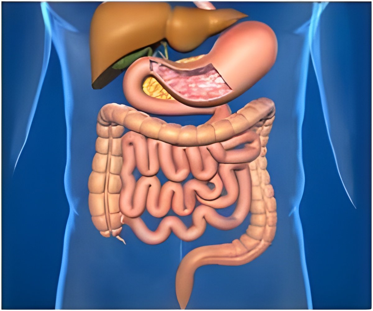 Potential Culprit Linked to Crohn’s Disease Symptoms Identified