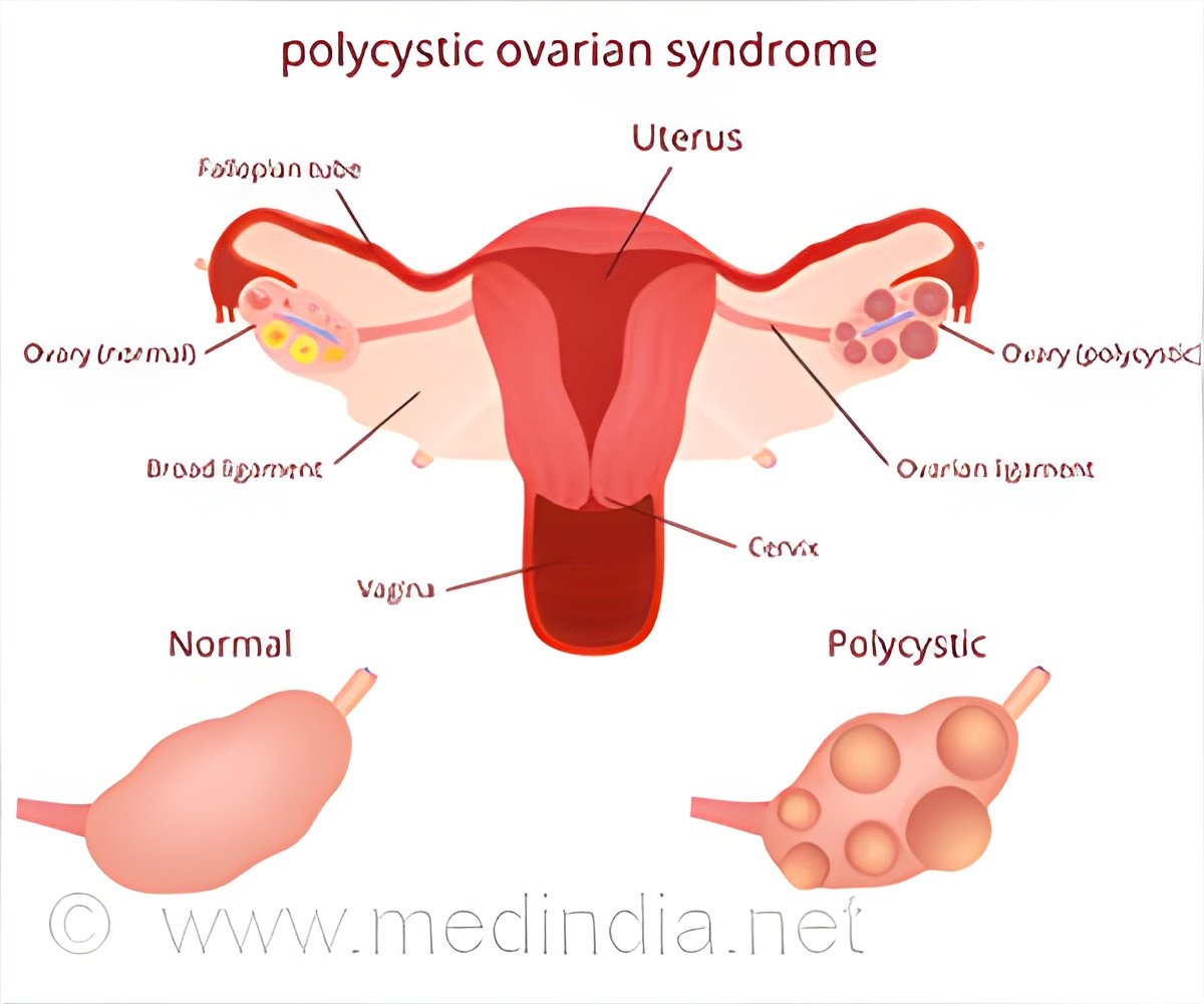 Novel Device to Treat Polycystic Ovarian Syndrome-Related Infertility