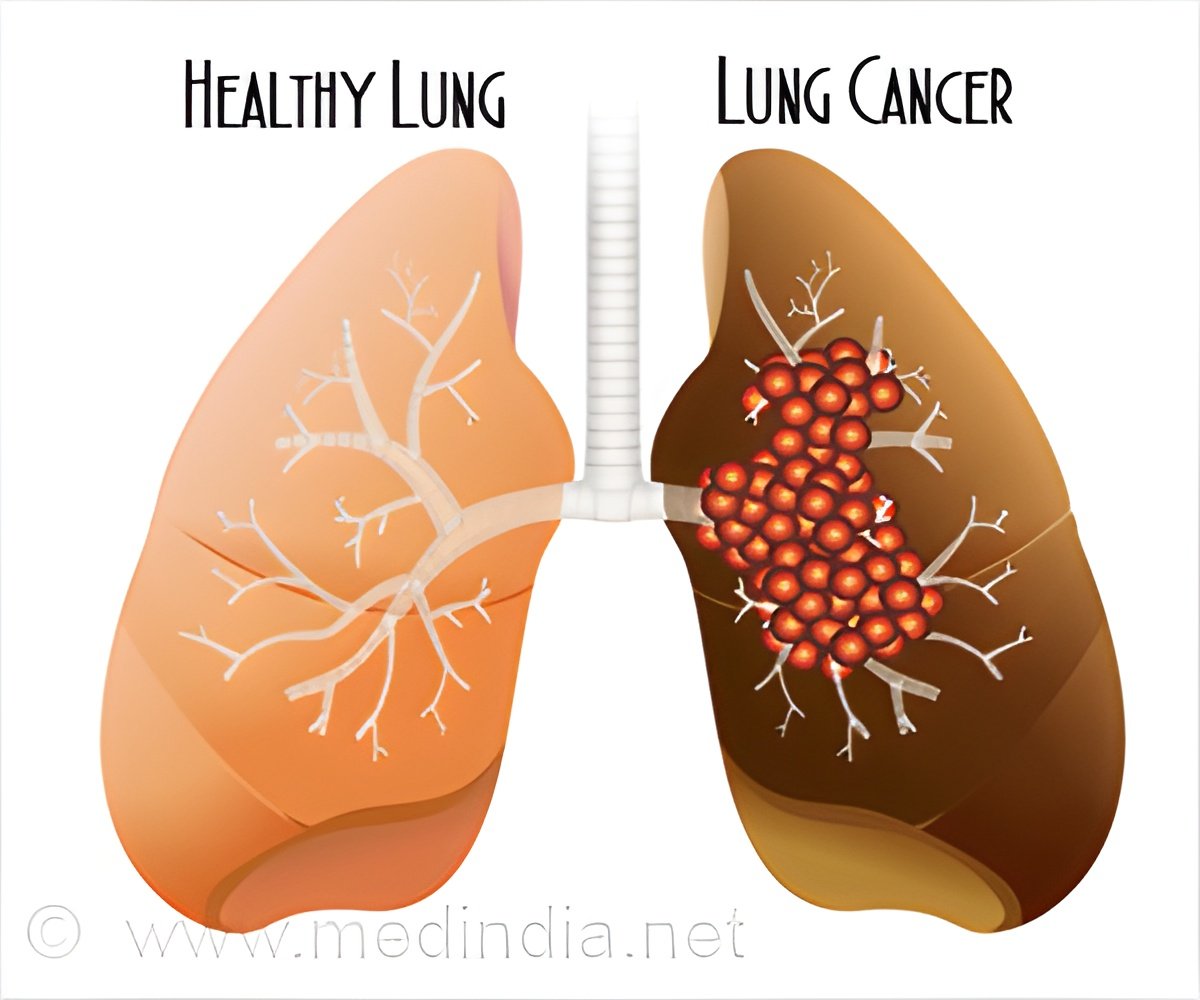 Cough Syrup Ingredient Dextromethorphan Promising for Lung Disease