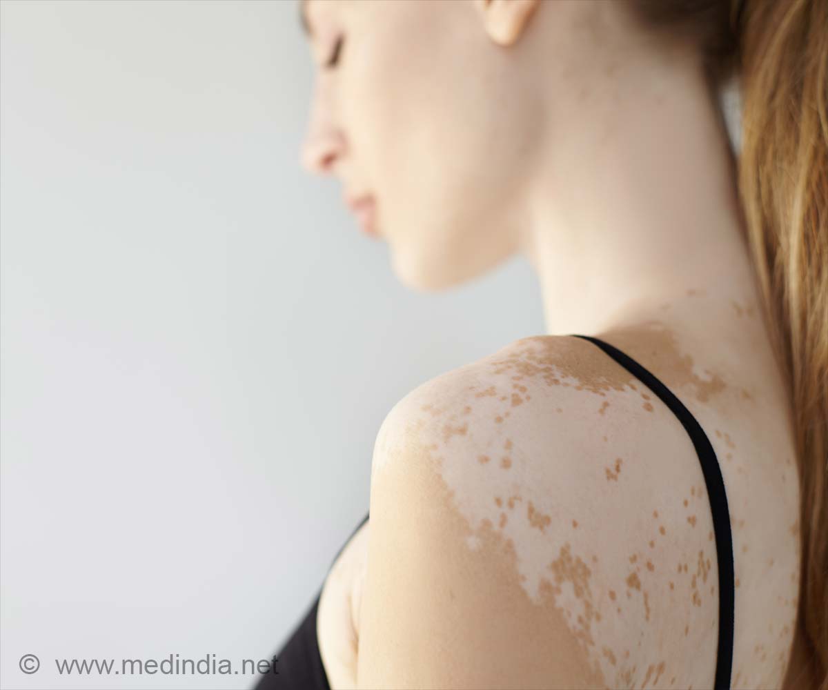 Bamboo and Coconut Oil a Remedy for Vitiligo?