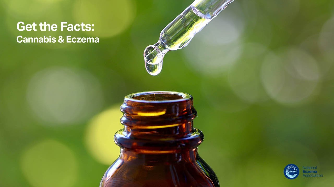 Get the Facts: Cannabis & Eczema