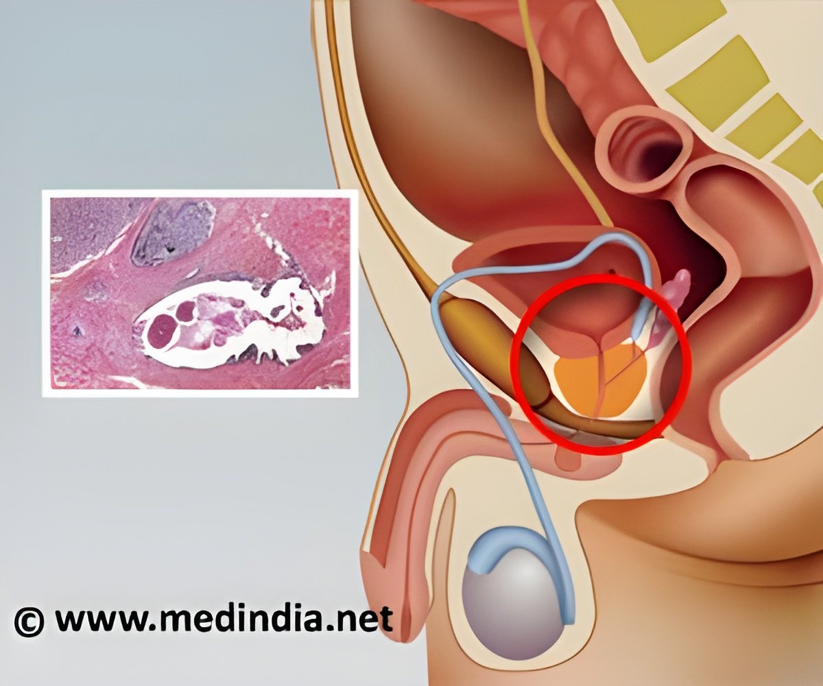 Advanced Imaging Reveals Metastatic Spread in High-Risk Prostate Cancer