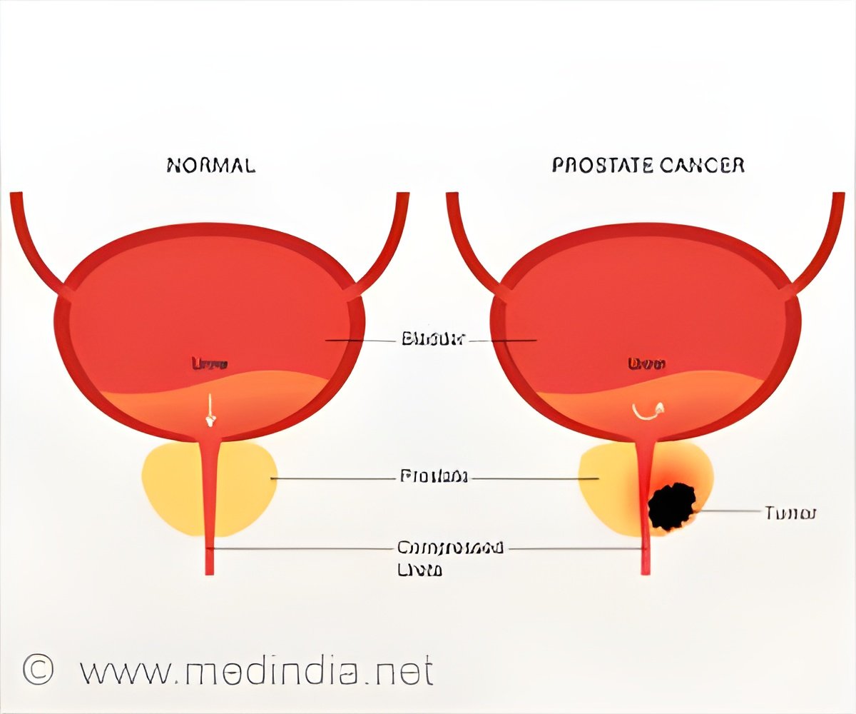 Could Targeted Steam Therapy Cure Prostate Cancer?